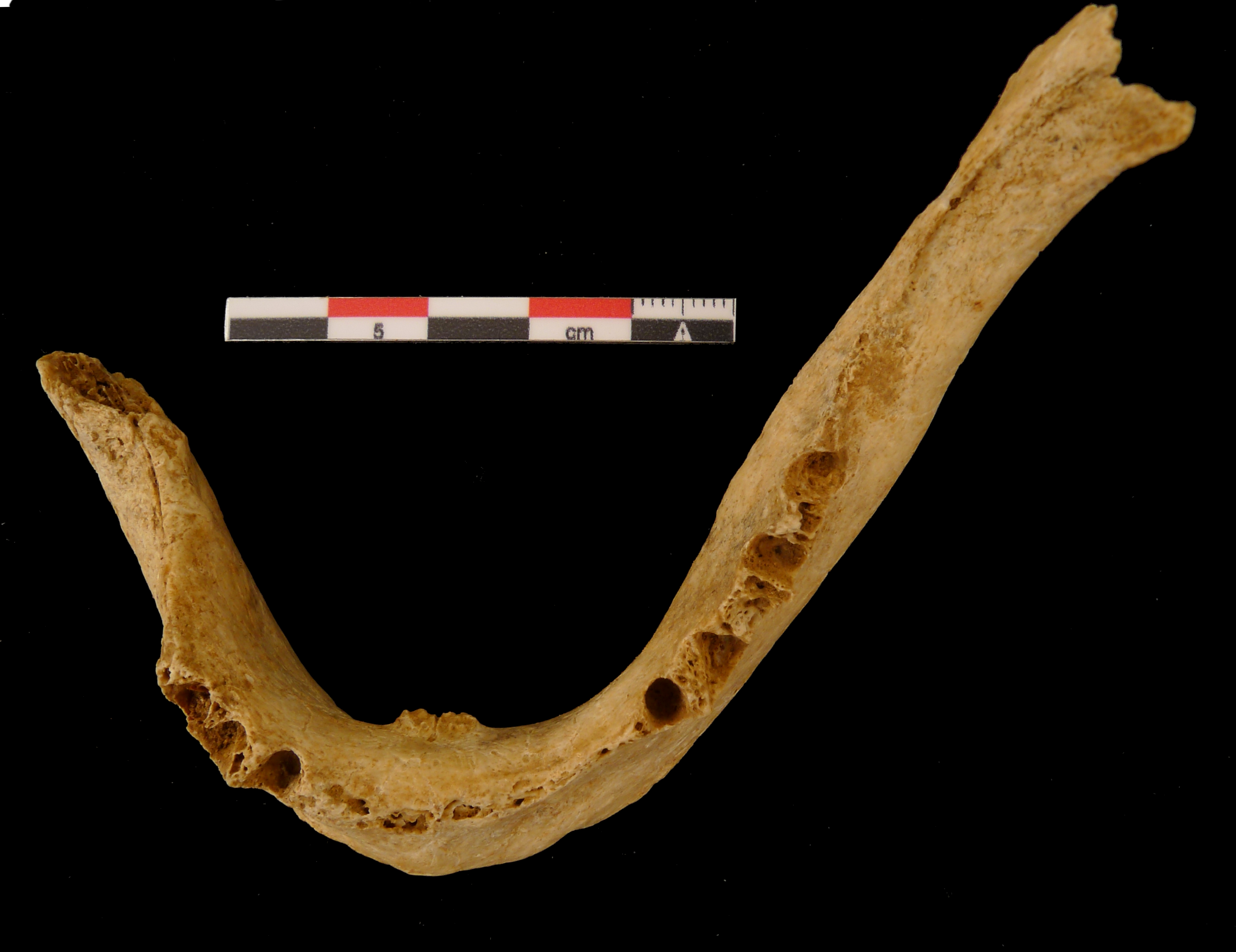 Mandibule inférieure d’une personne âgée qui n’était plus en mesure de mâcher avec les quelques dents fragmentaires qui lui restaient et plusieurs abcès (cliché D. Lubell)